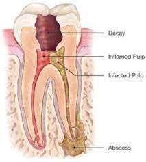 What is a Root Canal?  Root Canal Blogging & RCT Discussion